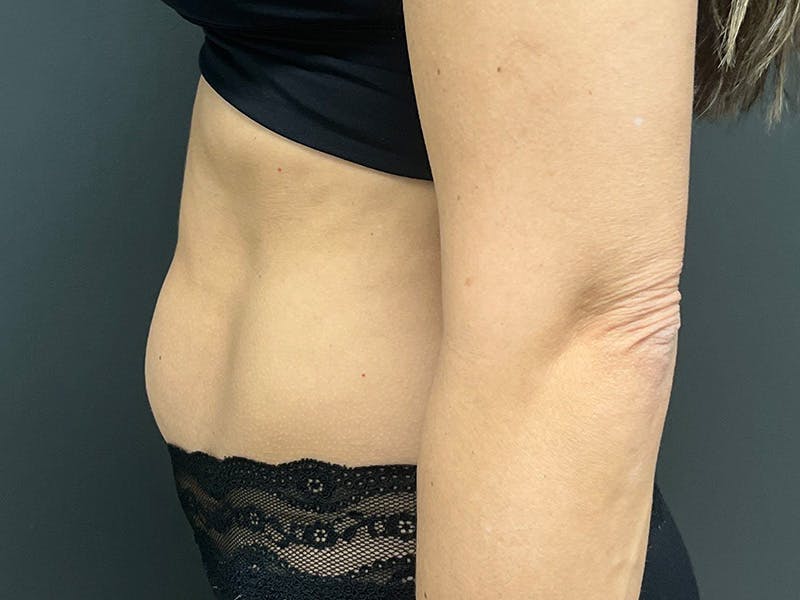 Mini Tummy Tuck Before & After Gallery - Patient 120272 - Image 9