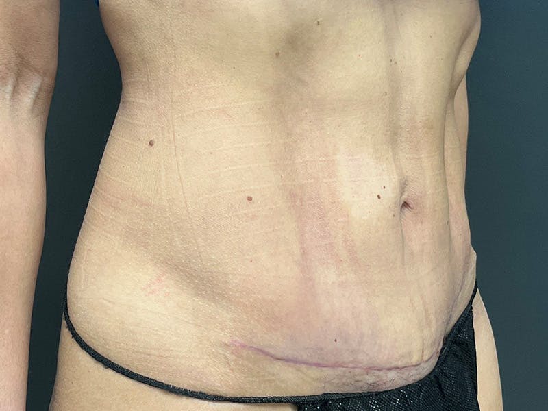 Mini Tummy Tuck Before & After Gallery - Patient 120272 - Image 4