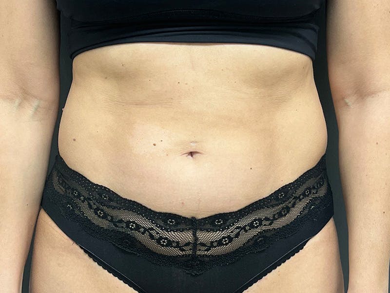 Mini Tummy Tuck Before & After Gallery - Patient 120272 - Image 1