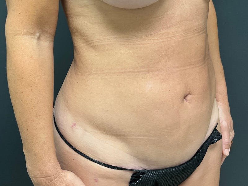 Mini Tummy Tuck Before & After Gallery - Patient 246074 - Image 4