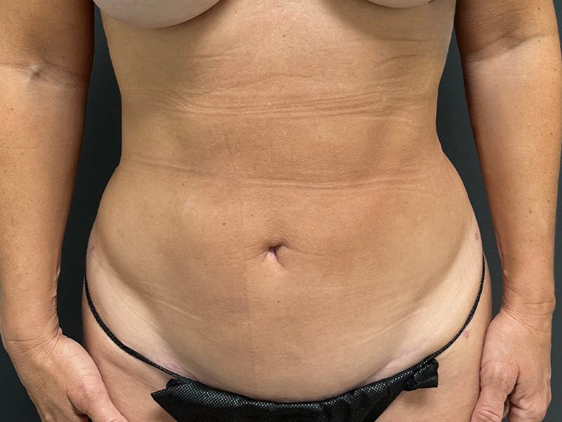 Mini Tummy Tuck Before & After Gallery - Patient 246074 - Image 2
