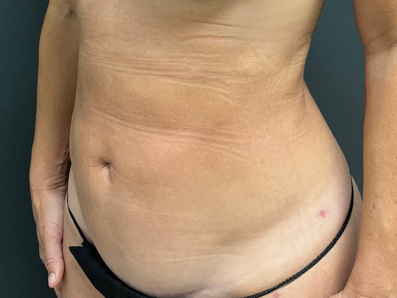 Mini Tummy Tuck Before & After Gallery - Patient 246074 - Image 8