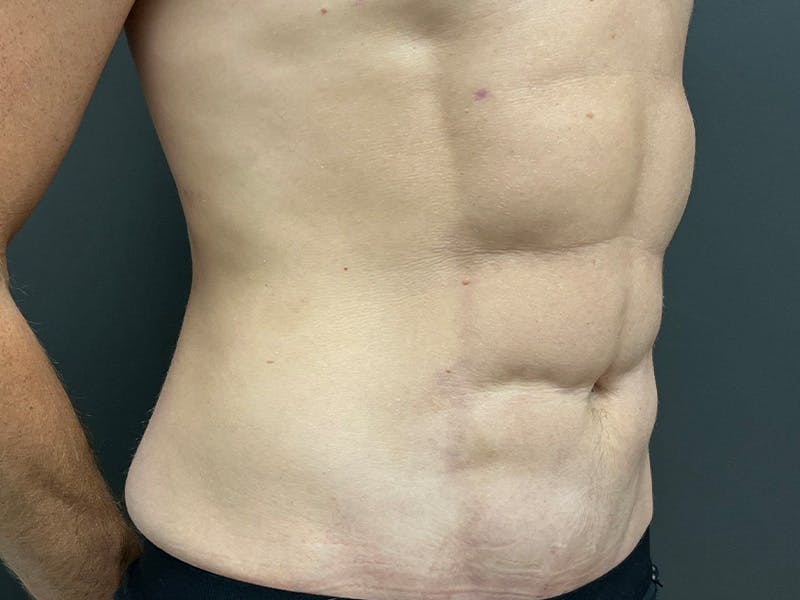 Mini Tummy Tuck Before & After Gallery - Patient 264633 - Image 4