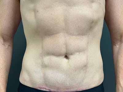 Mini Tummy Tuck Before & After Gallery - Patient 264633 - Image 2