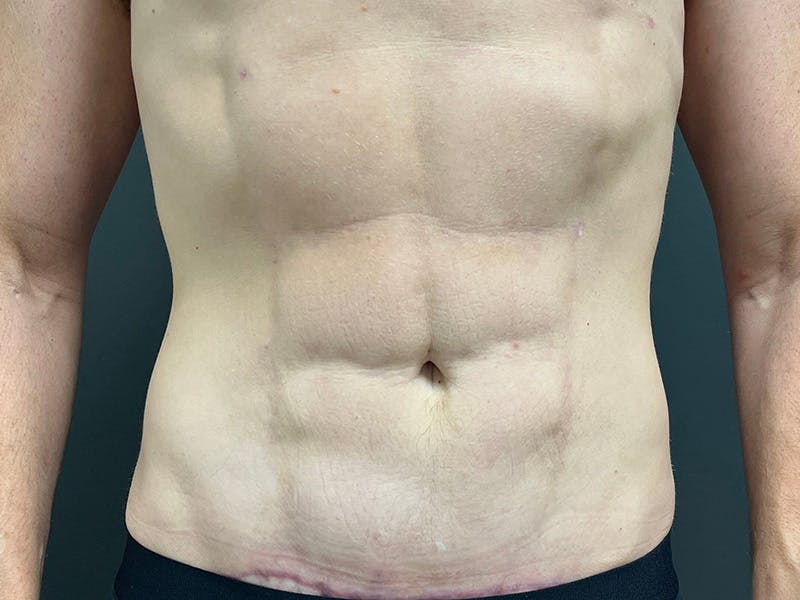 Mini Tummy Tuck Before & After Gallery - Patient 264633 - Image 2