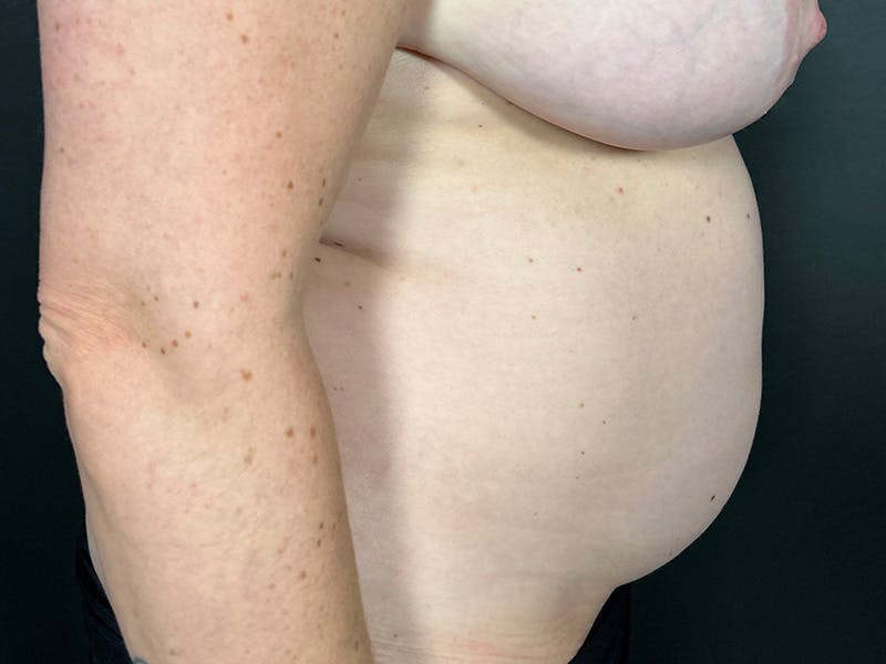 Mini Tummy Tuck Before & After Gallery - Patient 169656 - Image 5