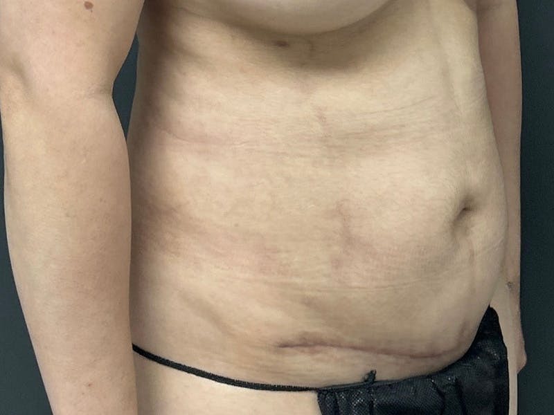 Mini Tummy Tuck Before & After Gallery - Patient 263277 - Image 4