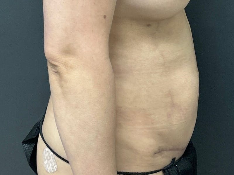 Mini Tummy Tuck Before & After Gallery - Patient 263277 - Image 6