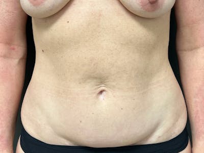 Mini Tummy Tuck Before & After Gallery - Patient 226626 - Image 1