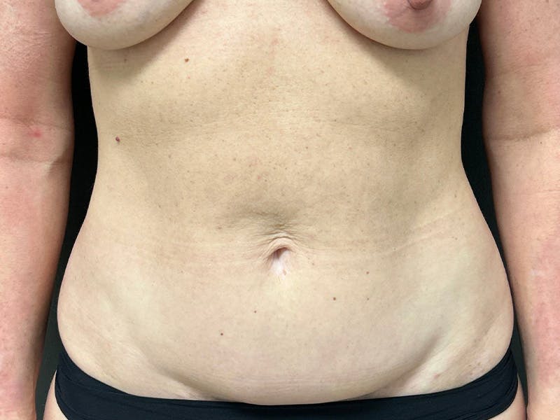 Mini Tummy Tuck Before & After Gallery - Patient 226626 - Image 1