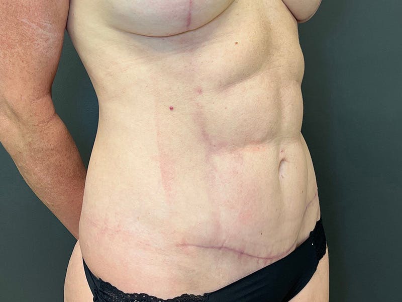 Mini Tummy Tuck Before & After Gallery - Patient 226626 - Image 4