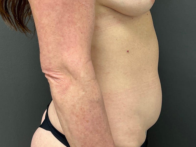 Mini Tummy Tuck Before & After Gallery - Patient 226626 - Image 5