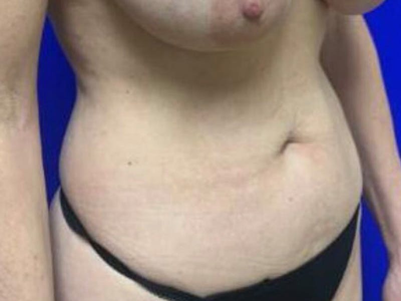 Mini Tummy Tuck Before & After Gallery - Patient 491163 - Image 4