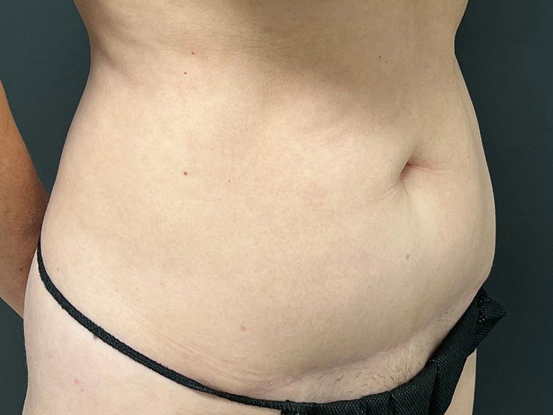 Mini Tummy Tuck Before & After Gallery - Patient 491163 - Image 3