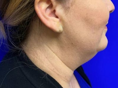 Submental Before & After Gallery - Patient 120511 - Image 1