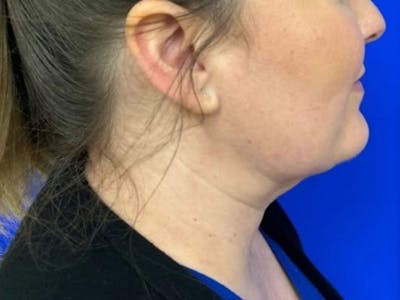 Submental Before & After Gallery - Patient 120511 - Image 2