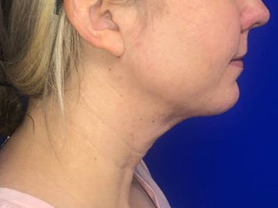 Submental Before & After Gallery - Patient 238853 - Image 2