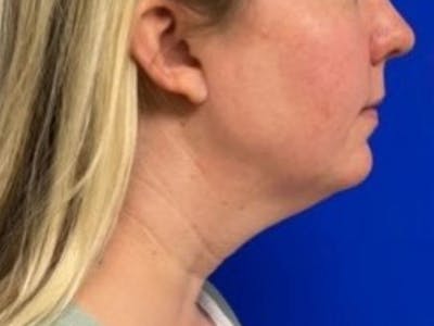 Submental Before & After Gallery - Patient 238853 - Image 1