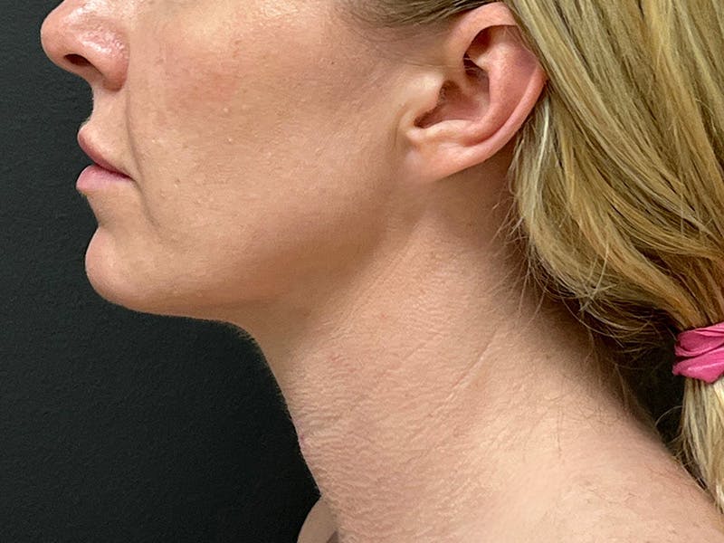 Submental Before & After Gallery - Patient 281129 - Image 10