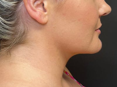 Submental Before & After Gallery - Patient 252708 - Image 2