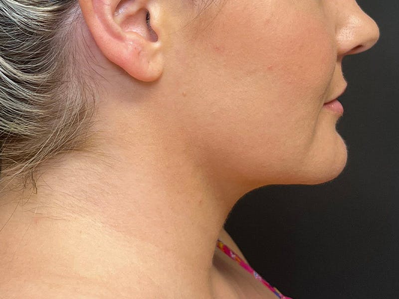 Submental Before & After Gallery - Patient 252708 - Image 2