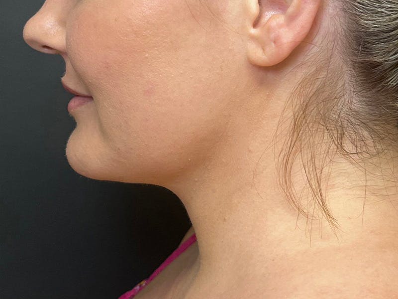 Submental Before & After Gallery - Patient 252708 - Image 10