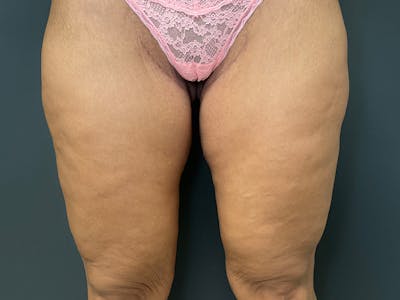 Thigh Lift Before & After Gallery - Patient 128992 - Image 2