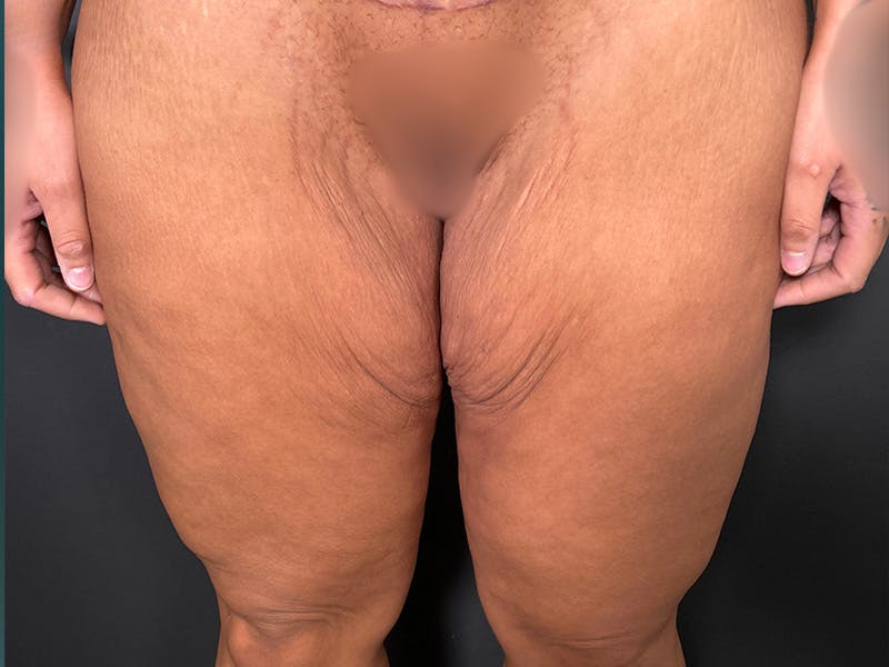 Thigh Lift Before & After Gallery - Patient 128992 - Image 1