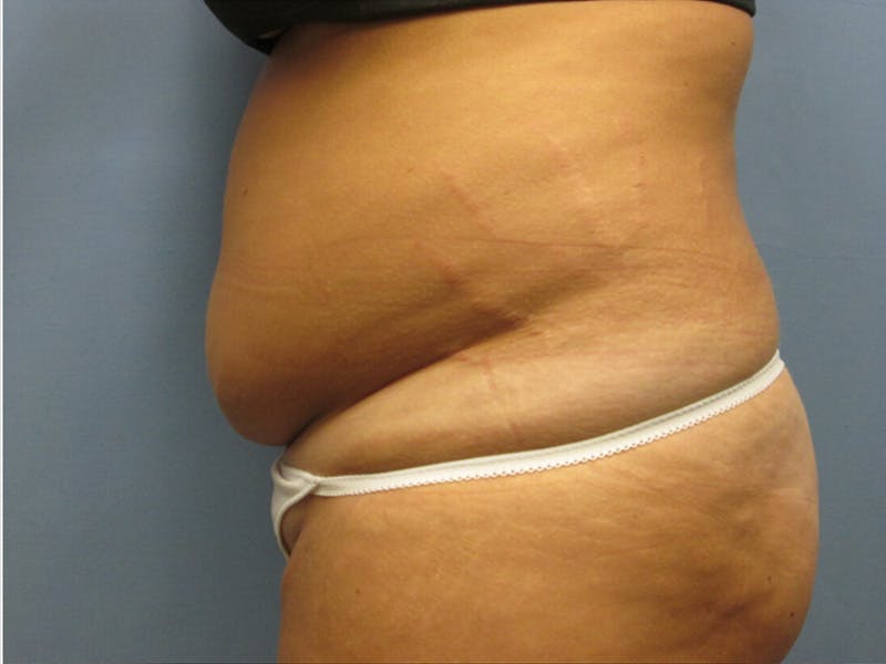 Abdomen Before & After Gallery - Patient 254696 - Image 3