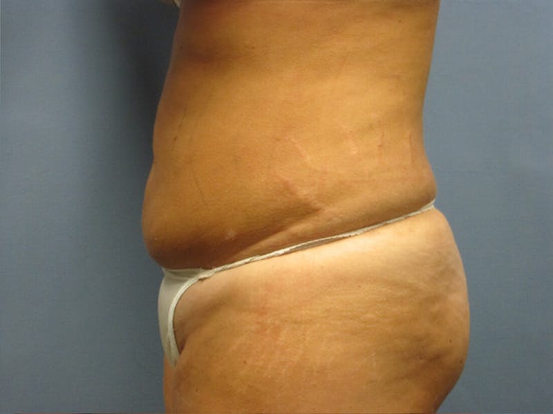 Abdomen Before & After Gallery - Patient 254696 - Image 4