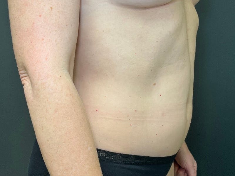 Abdomen Before & After Gallery - Patient 151954 - Image 4