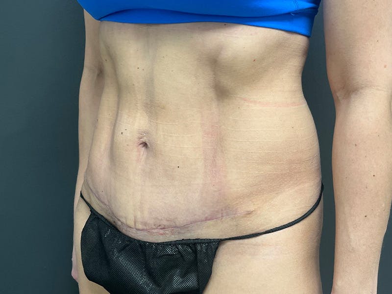 Abdomen Before & After Gallery - Patient 158442 - Image 8