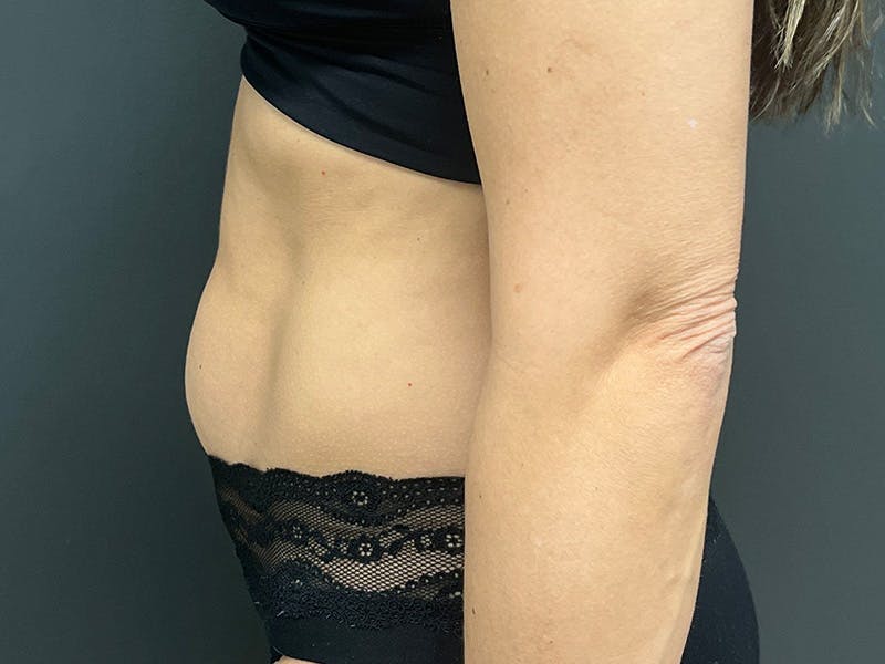 Abdomen Before & After Gallery - Patient 158442 - Image 9