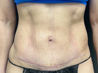 Abdomen Before & After Gallery - Patient 158442 - Image 2