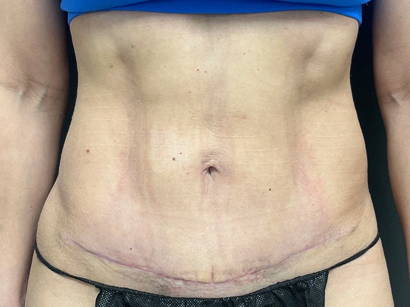 Abdomen Before & After Gallery - Patient 158442 - Image 2