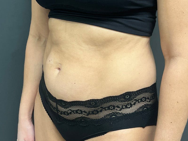 Abdomen Before & After Gallery - Patient 158442 - Image 7