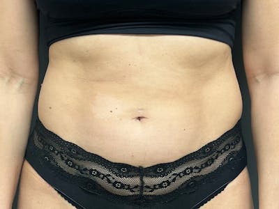 Abdomen Before & After Gallery - Patient 158442 - Image 1