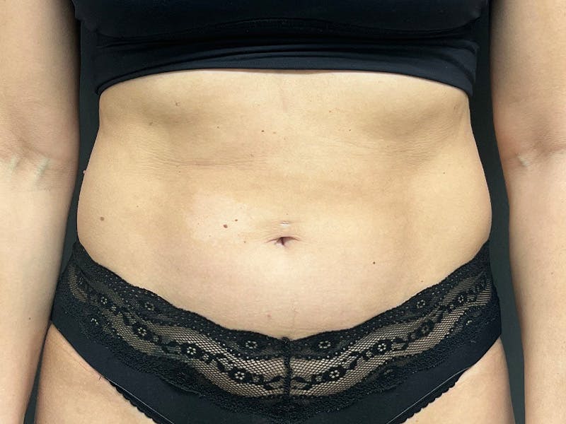 Abdomen Before & After Gallery - Patient 158442 - Image 1
