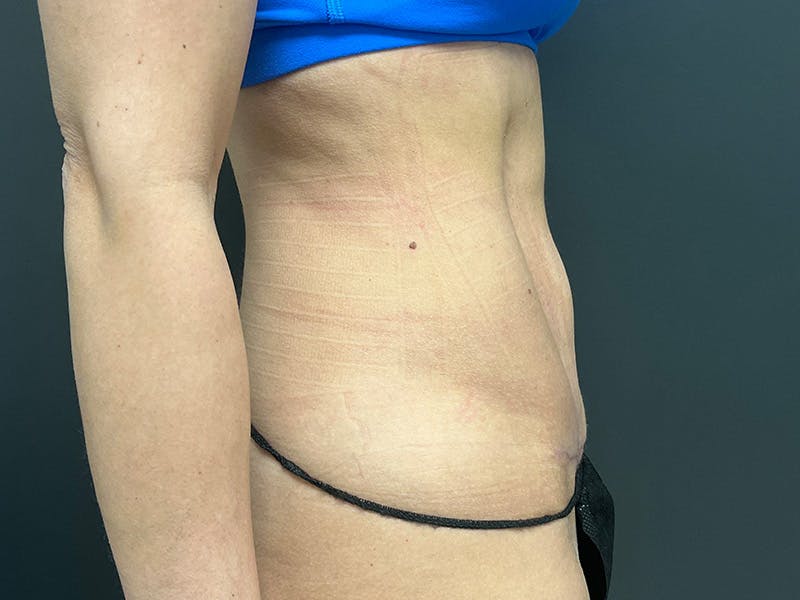 Abdomen Before & After Gallery - Patient 158442 - Image 6