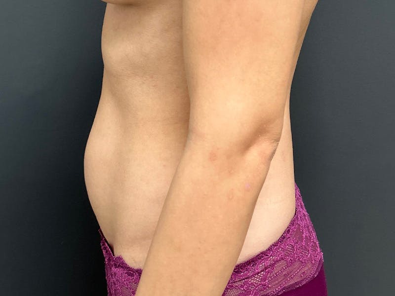 Abdomen Before & After Gallery - Patient 171479 - Image 9