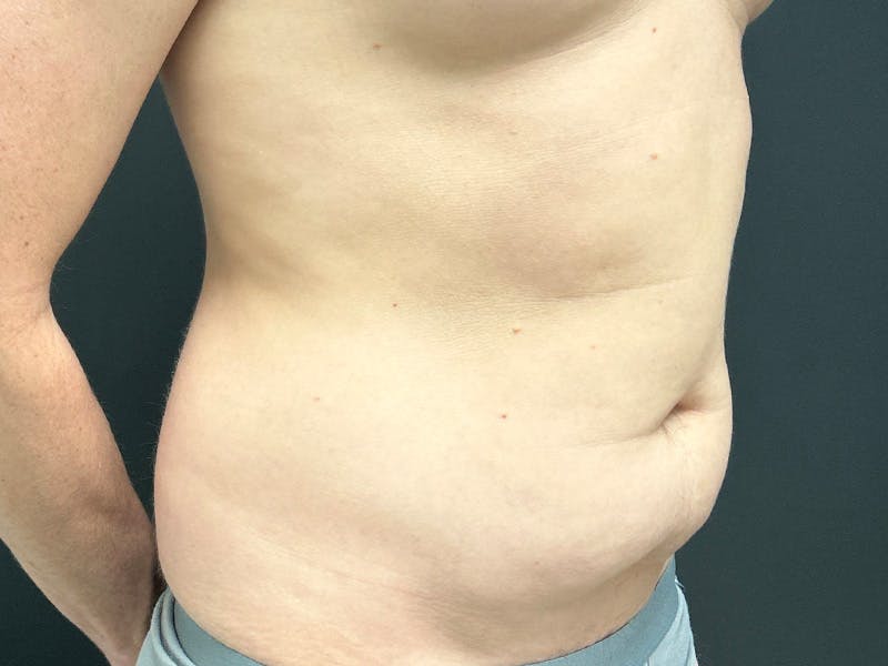 Abdomen Before & After Gallery - Patient 406127 - Image 3