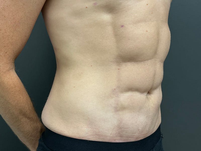 Abdomen Before & After Gallery - Patient 406127 - Image 4