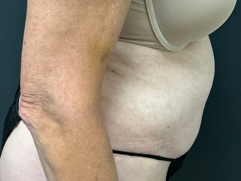 Abdomen Before & After Gallery - Patient 784997 - Image 5