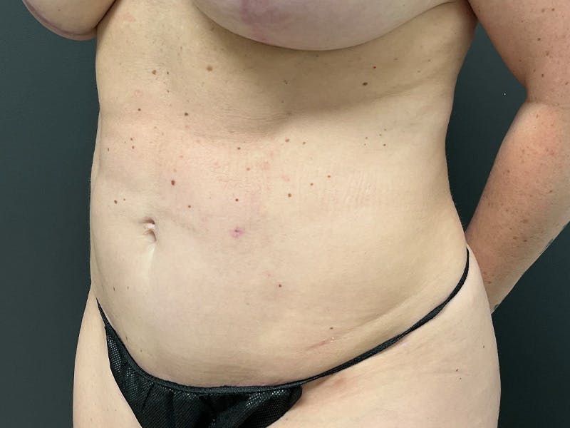 Abdomen Before & After Gallery - Patient 419008 - Image 8
