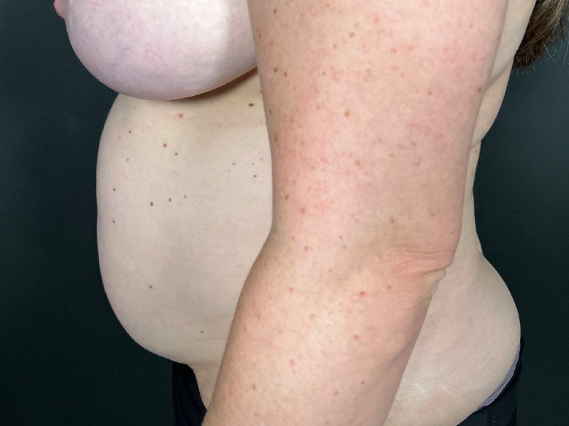 Abdomen Before & After Gallery - Patient 419008 - Image 9