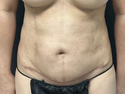 Abdomen Before & After Gallery - Patient 153440 - Image 2