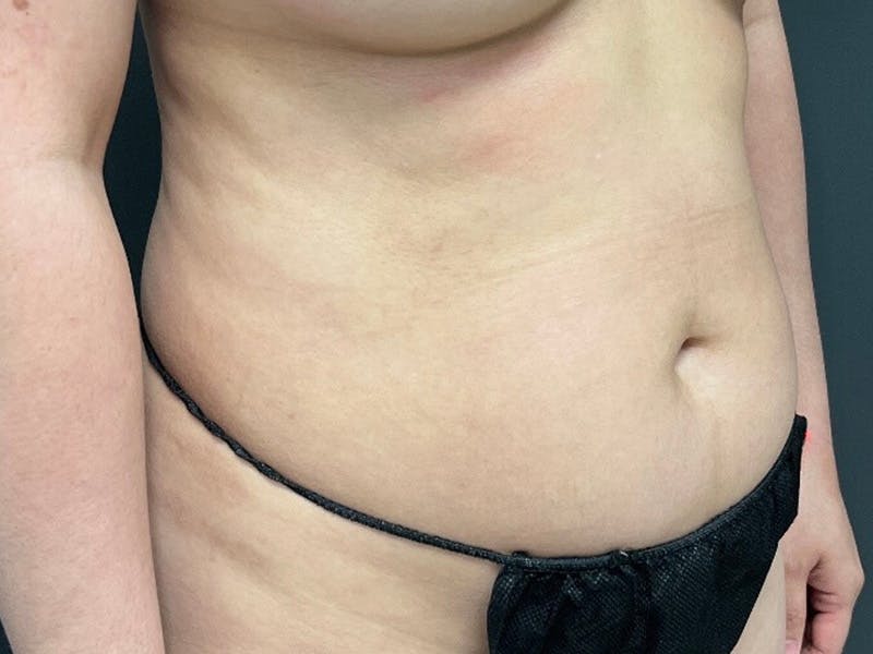 Abdomen Before & After Gallery - Patient 153440 - Image 3