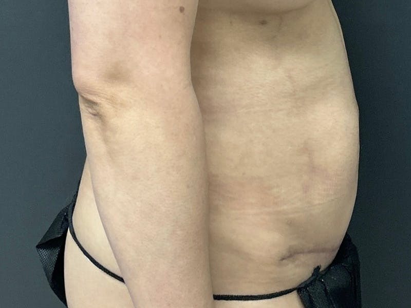Abdomen Before & After Gallery - Patient 153440 - Image 6