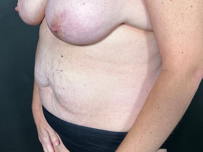 Abdomen Before & After Gallery - Patient 924975 - Image 7