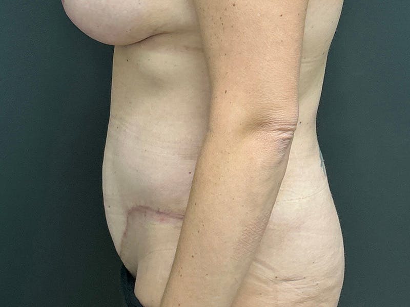 Abdomen Before & After Gallery - Patient 924975 - Image 10